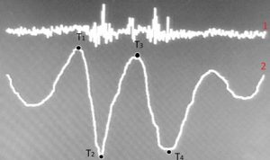 Figure 4. 1 - uninformative signal; 2 – exhalation with the oscillatory diaphragm movement